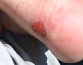 Blister