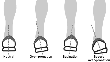 Types of pronation