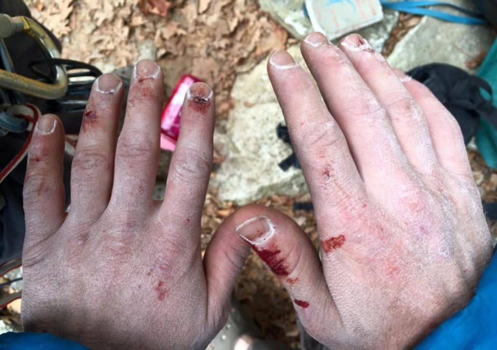 A photo of rough hands and scrapes