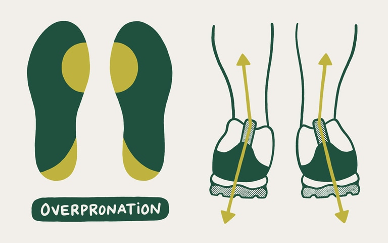 An illustration of overpronation